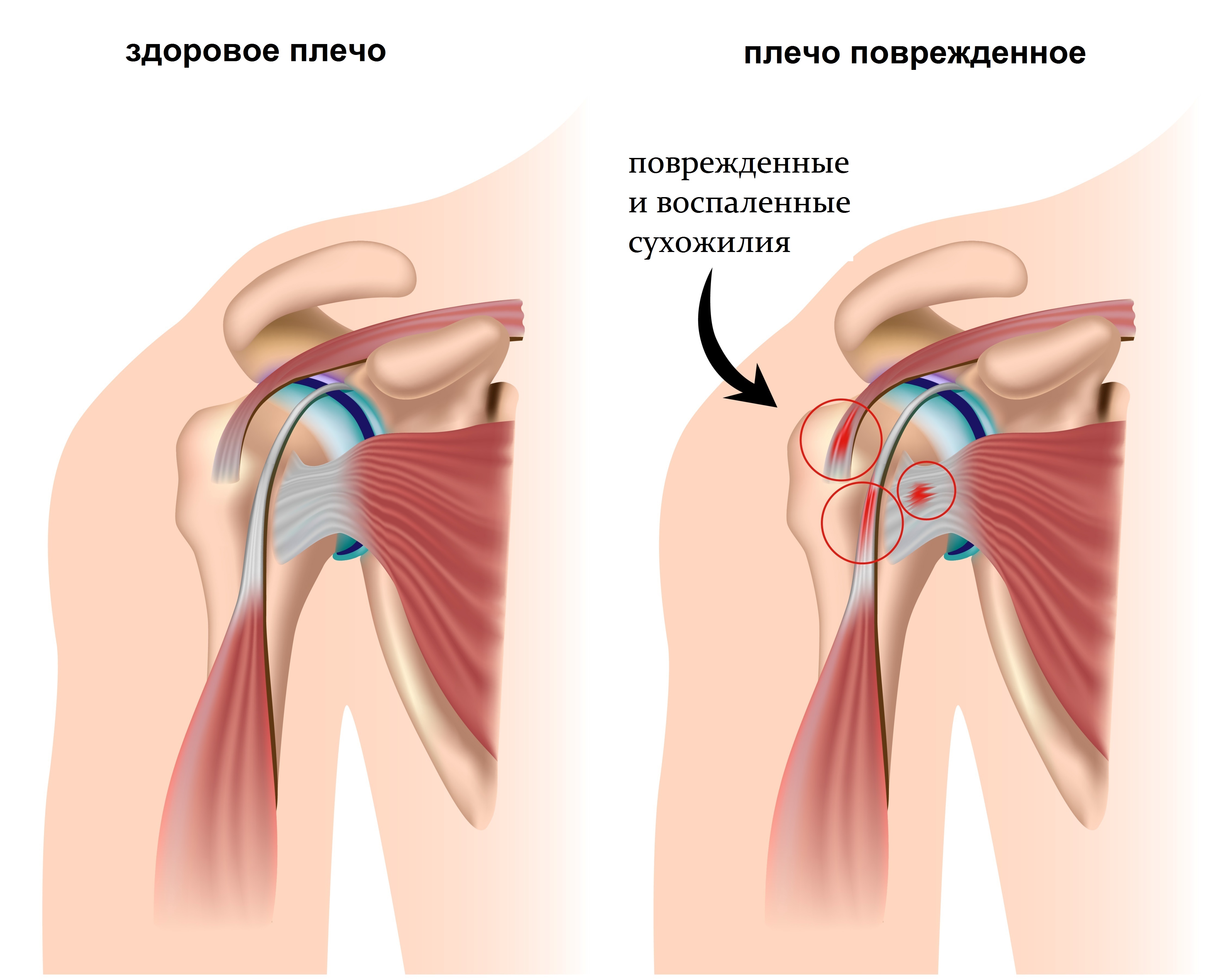 біль  уплечі