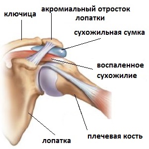 Плечолопатковий періатріт
